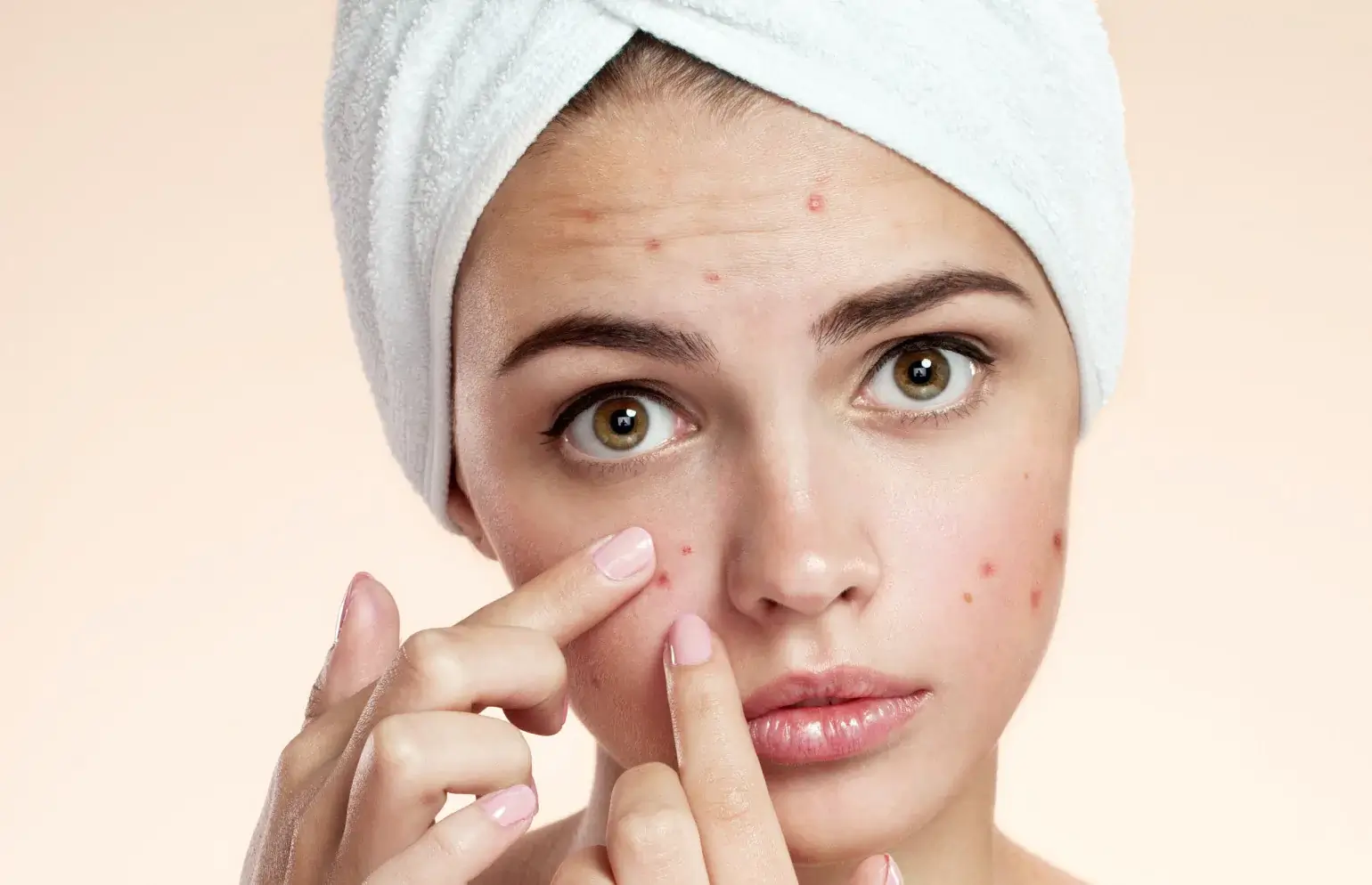 Acne-fighting medication