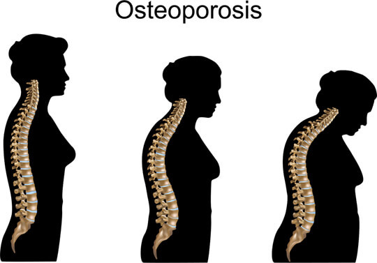 Certain Medical Conditions Like Osteoporosis